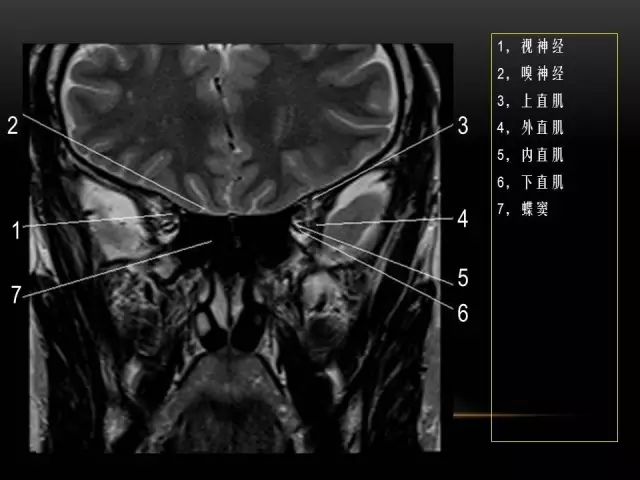 影像PPT - MRI下的眼部及鼻窦解剖-16