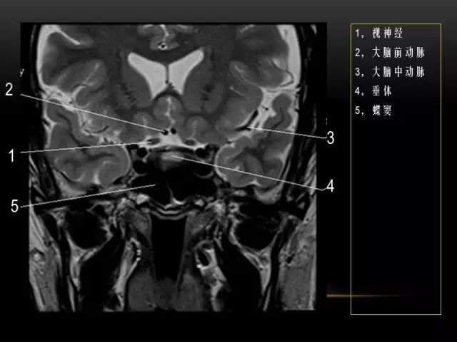 影像PPT - MRI下的眼部及鼻窦解剖-20