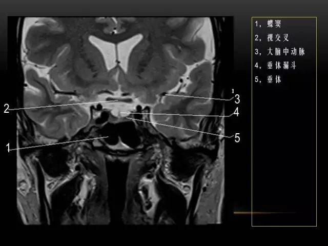 影像PPT - MRI下的眼部及鼻窦解剖-21