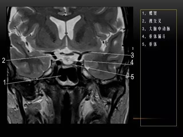 影像PPT - MRI下的眼部及鼻窦解剖-22