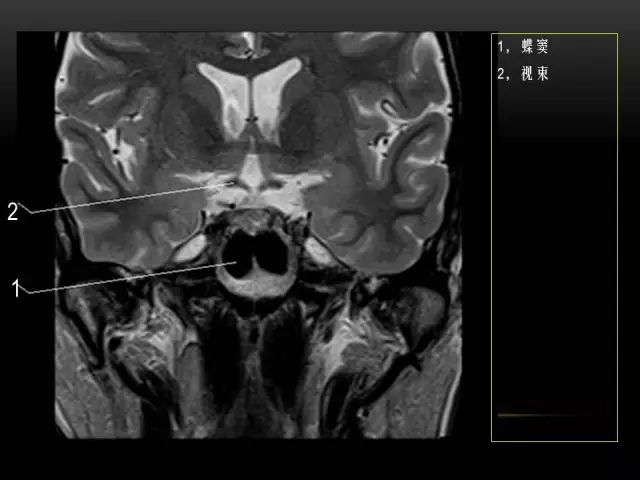 影像PPT - MRI下的眼部及鼻窦解剖-23