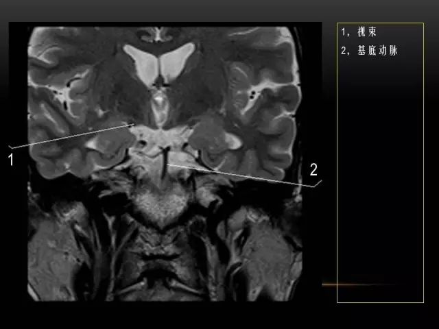 影像PPT - MRI下的眼部及鼻窦解剖-25