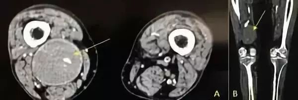 影像PPT - 腘窝肿块荟萃-26 影像PPT - 腘窝肿块荟萃-26