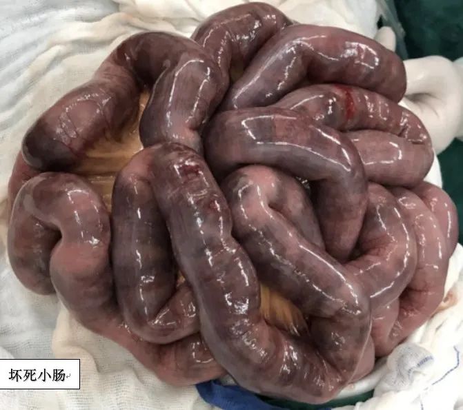 影像PPT - 七旬老人遭遇“死神之征”-4 影像PPT - 七旬老人遭遇“死神之征”-4