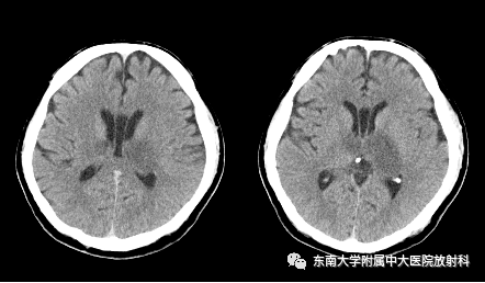 影像PPT - 【PPT】颅内静脉血栓影像诊断-1