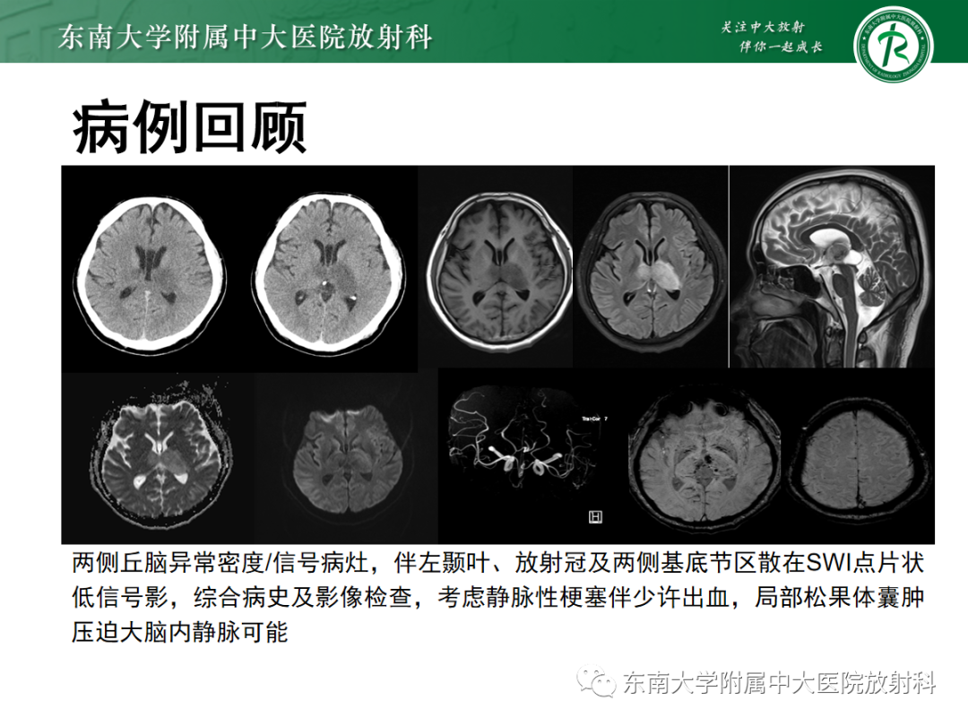 影像PPT - 【PPT】颅内静脉血栓影像诊断-5