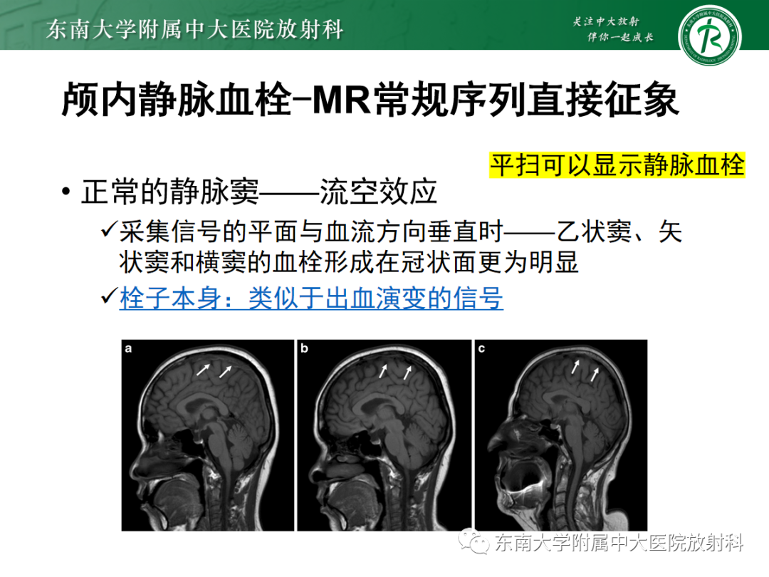 影像PPT - 【PPT】颅内静脉血栓影像诊断-23