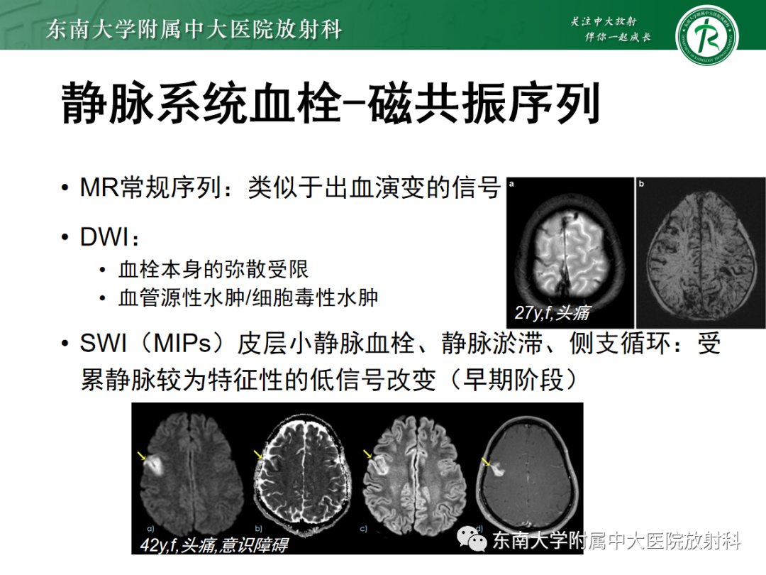 影像PPT - 【PPT】颅内静脉血栓影像诊断-22