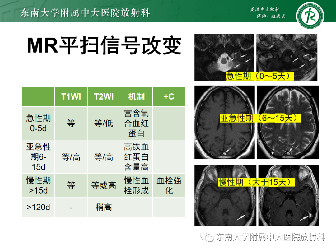 影像PPT - 【PPT】颅内静脉血栓影像诊断-24