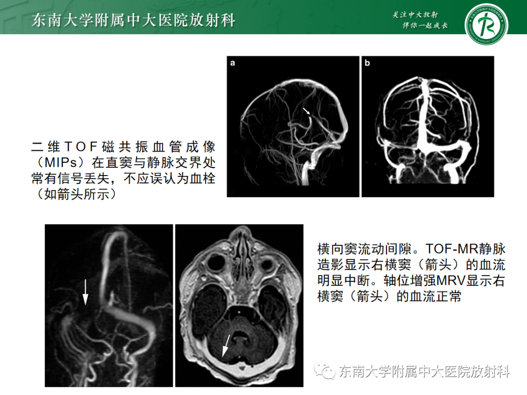 影像PPT - 【PPT】颅内静脉血栓影像诊断-26