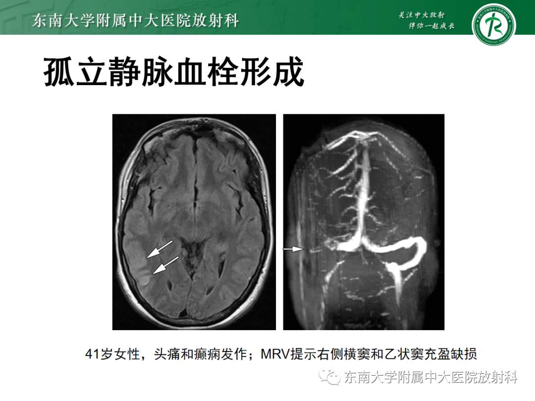 影像PPT - 【PPT】颅内静脉血栓影像诊断-29