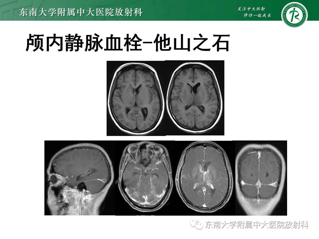 影像PPT - 【PPT】颅内静脉血栓影像诊断-31