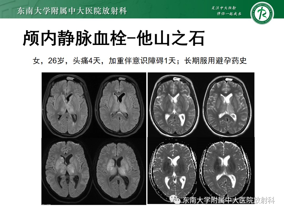 影像PPT - 【PPT】颅内静脉血栓影像诊断-30