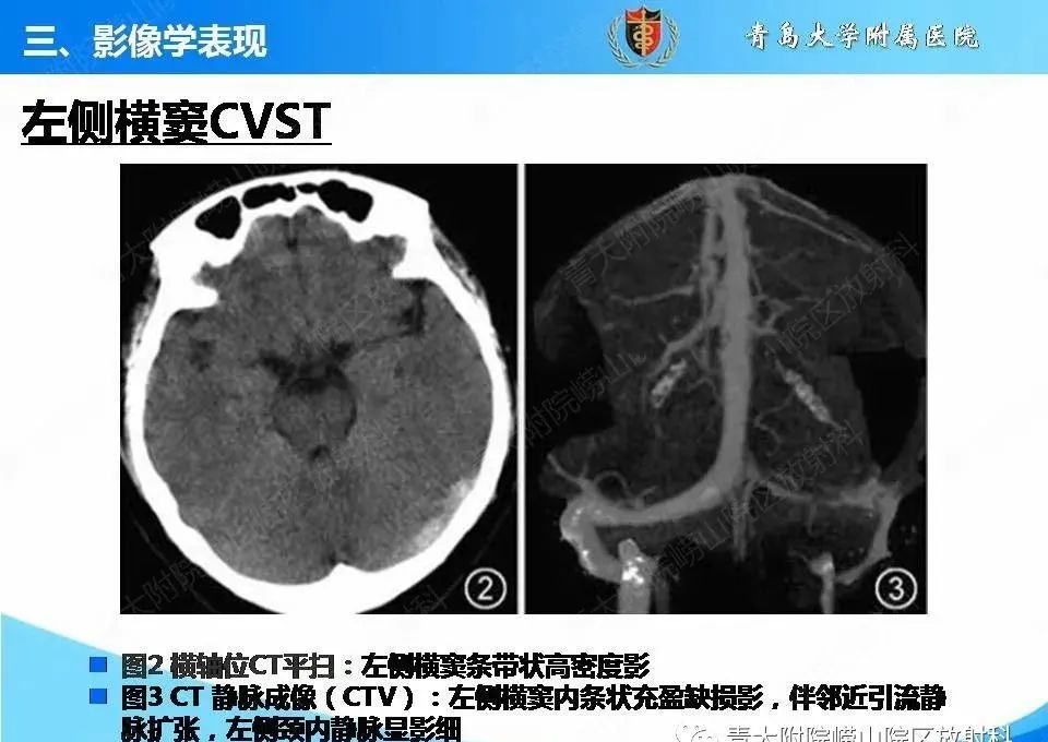 影像PPT - 【PPT】脑静脉窦血栓形成的影像学诊断及预后评估-15