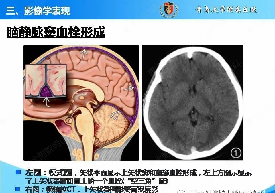 影像PPT - 【PPT】脑静脉窦血栓形成的影像学诊断及预后评估-13