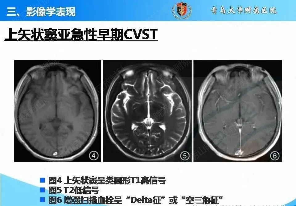 影像PPT - 【PPT】脑静脉窦血栓形成的影像学诊断及预后评估-20