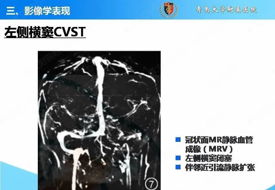 影像PPT - 【PPT】脑静脉窦血栓形成的影像学诊断及预后评估-22