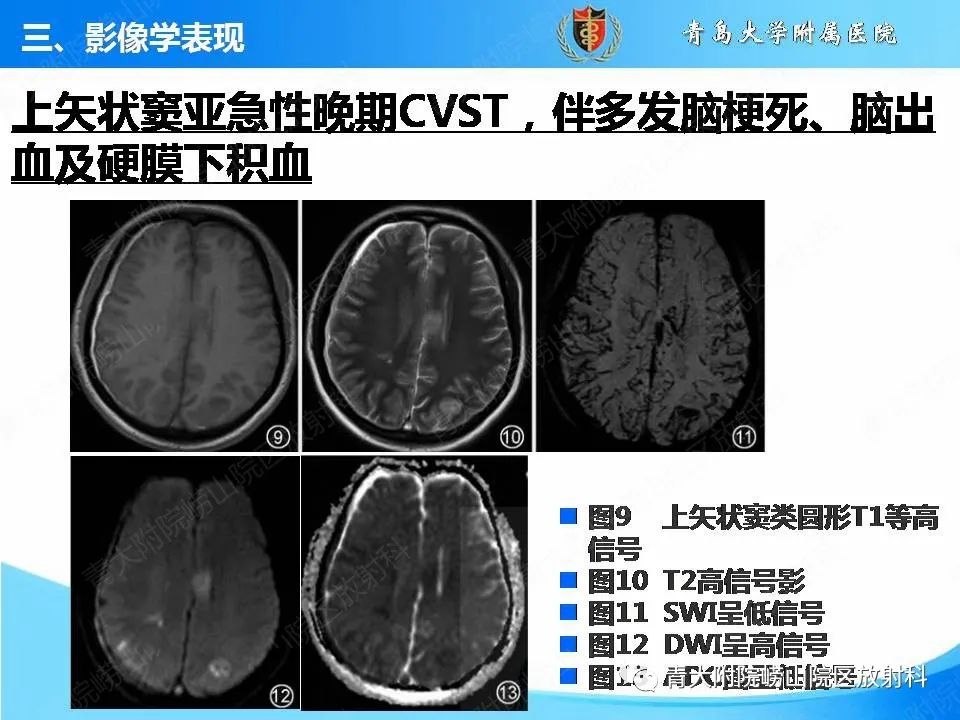 影像PPT - 【PPT】脑静脉窦血栓形成的影像学诊断及预后评估-26