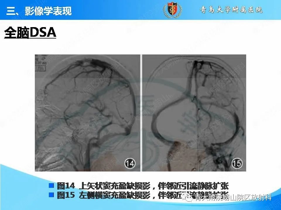 影像PPT - 【PPT】脑静脉窦血栓形成的影像学诊断及预后评估-28