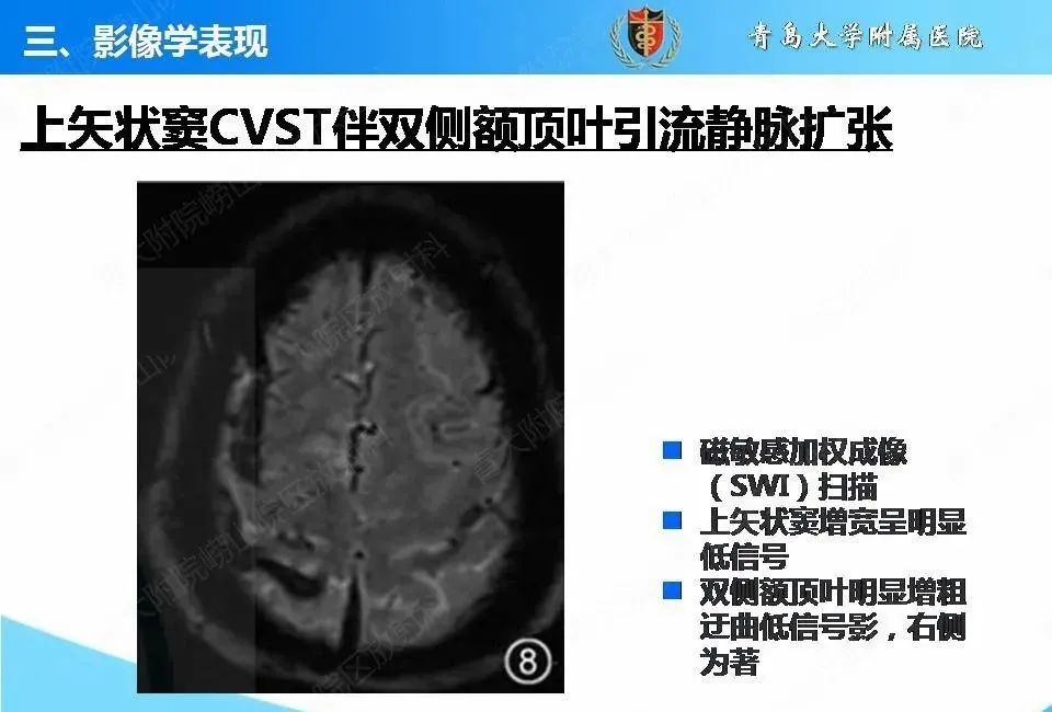 影像PPT - 【PPT】脑静脉窦血栓形成的影像学诊断及预后评估-24