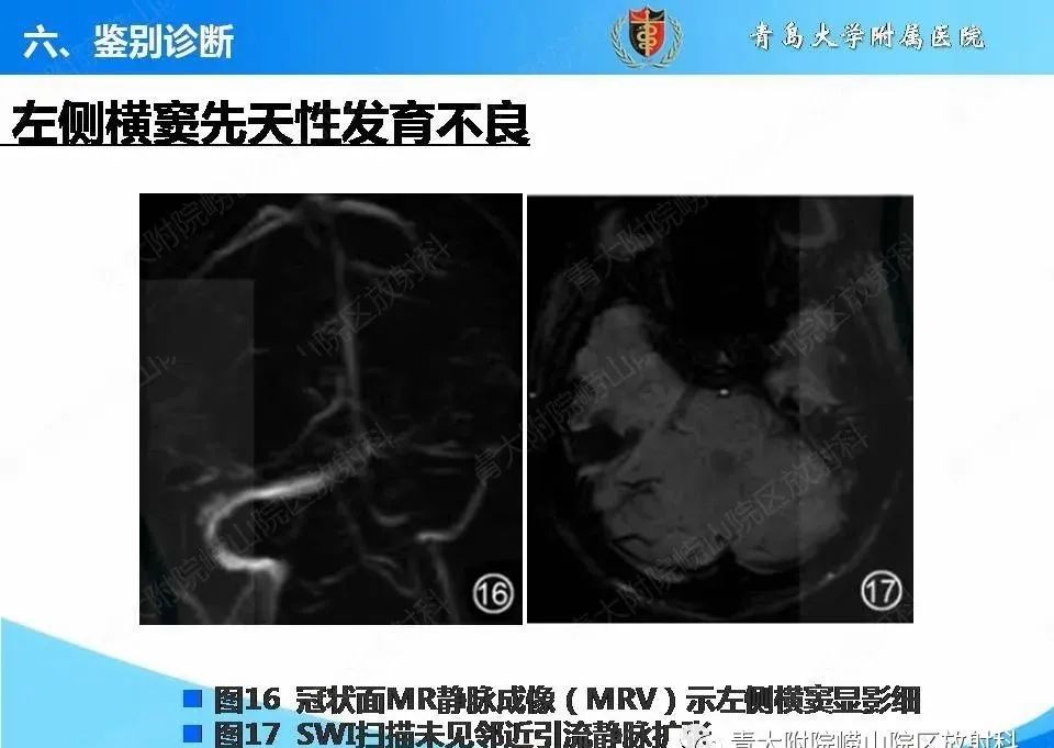 影像PPT - 【PPT】脑静脉窦血栓形成的影像学诊断及预后评估-30