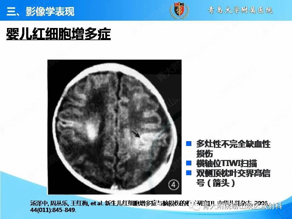 影像PPT - 【PPT】脑静脉窦血栓形成的影像学诊断及预后评估-32