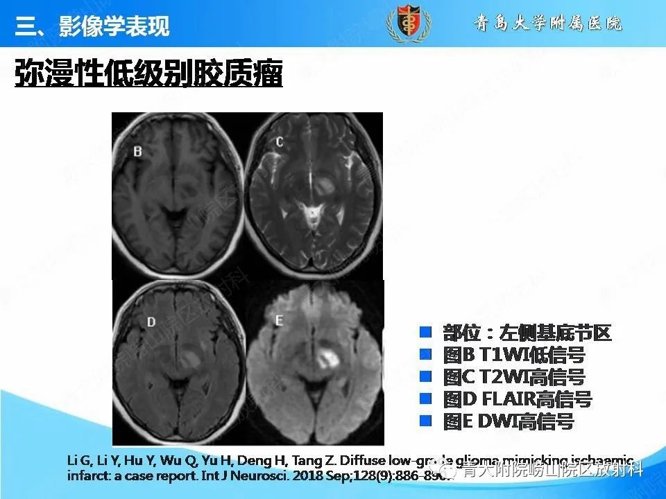影像PPT - 【PPT】脑静脉窦血栓形成的影像学诊断及预后评估-36
