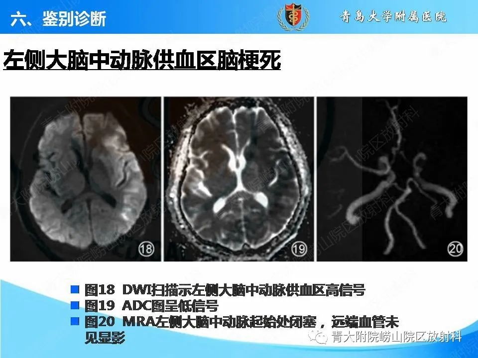 影像PPT - 【PPT】脑静脉窦血栓形成的影像学诊断及预后评估-34