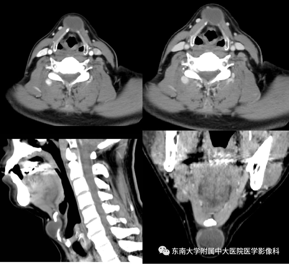影像PPT - 【PPT】异位甲状腺、甲状舌管囊肿影像表现-2