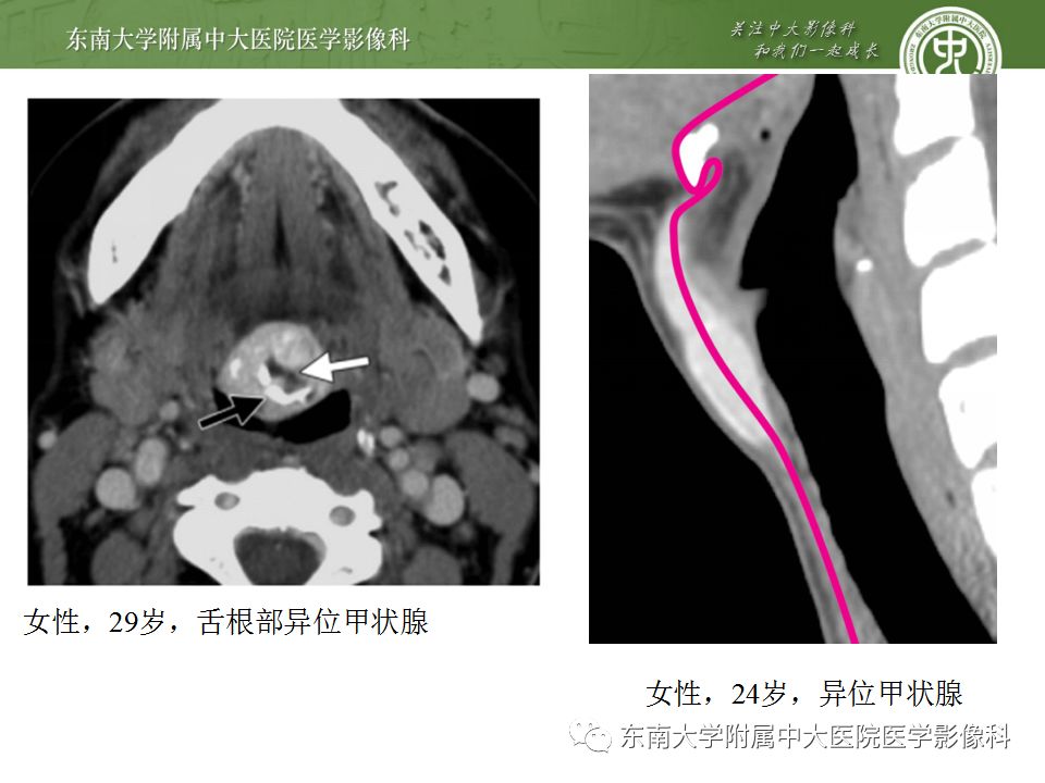 影像PPT - 【PPT】异位甲状腺、甲状舌管囊肿影像表现-9