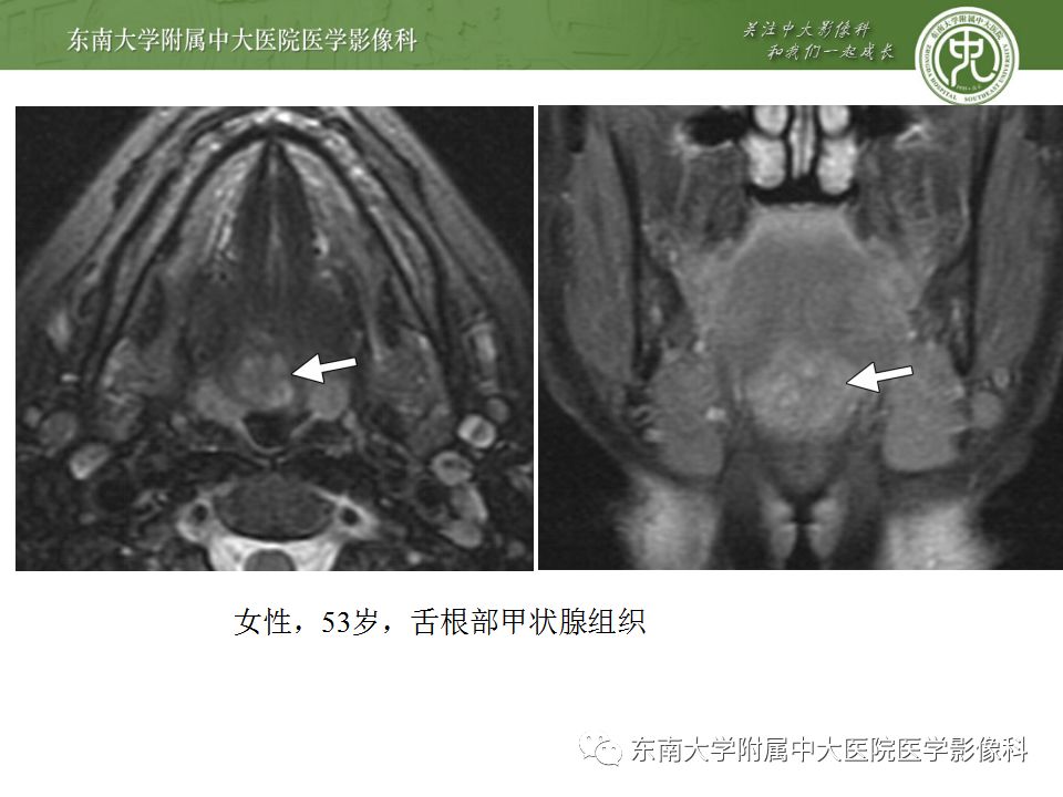 影像PPT - 【PPT】异位甲状腺、甲状舌管囊肿影像表现-10