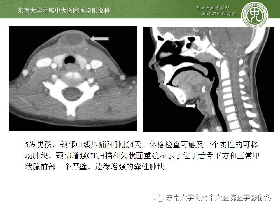 影像PPT - 【PPT】异位甲状腺、甲状舌管囊肿影像表现-13
