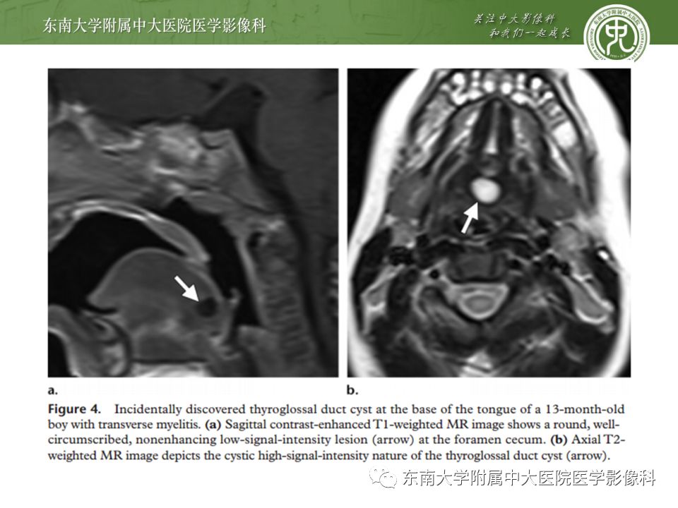 影像PPT - 【PPT】异位甲状腺、甲状舌管囊肿影像表现-14
