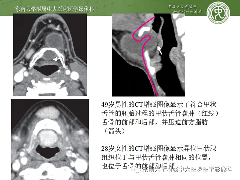 影像PPT - 【PPT】异位甲状腺、甲状舌管囊肿影像表现-16
