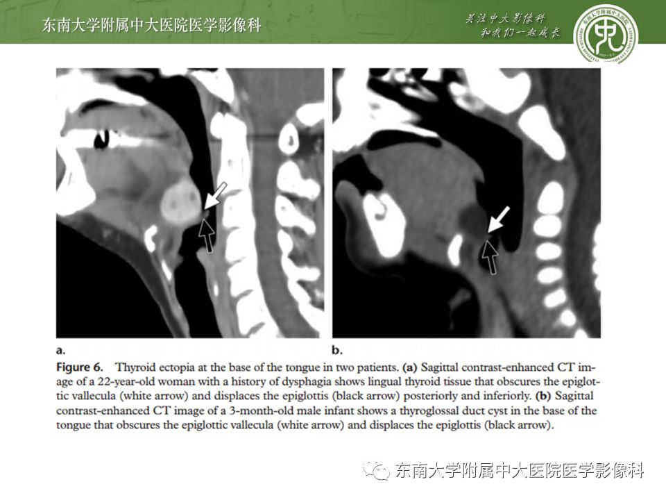 影像PPT - 【PPT】异位甲状腺、甲状舌管囊肿影像表现-15