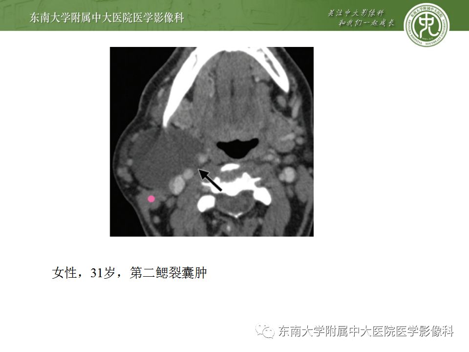 影像PPT - 【PPT】异位甲状腺、甲状舌管囊肿影像表现-19