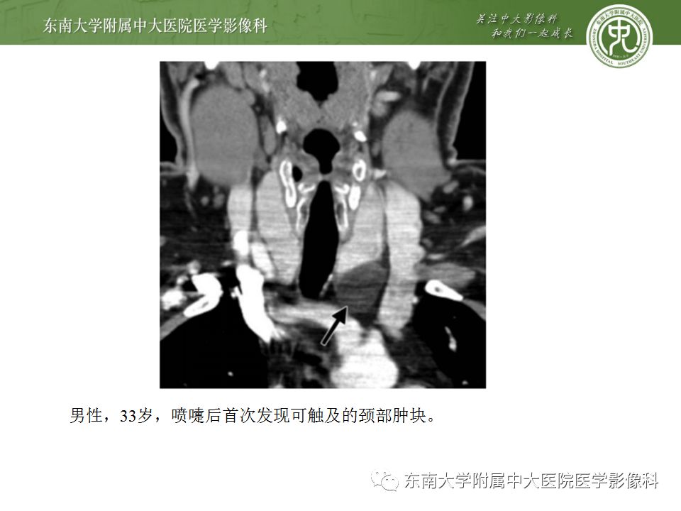 影像PPT - 【PPT】异位甲状腺、甲状舌管囊肿影像表现-23