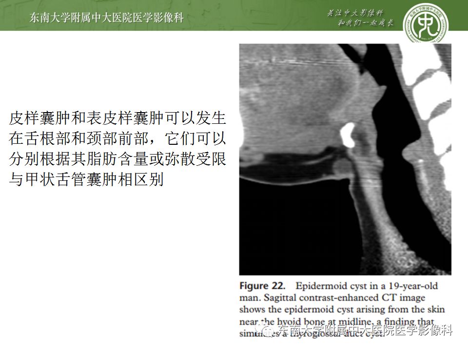 影像PPT - 【PPT】异位甲状腺、甲状舌管囊肿影像表现-21