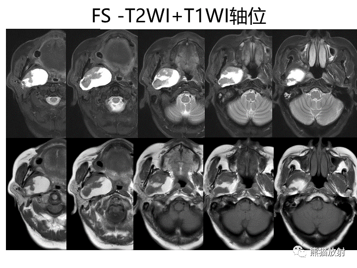 影像PPT - 【病例】咽旁多形性腺瘤VS神经鞘瘤-4