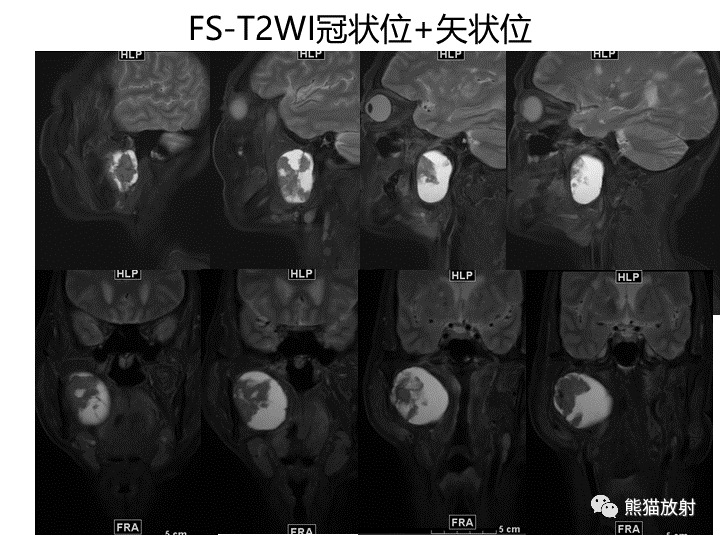 影像PPT - 【病例】咽旁多形性腺瘤VS神经鞘瘤-3