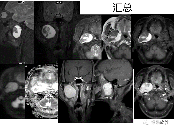 影像PPT - 【病例】咽旁多形性腺瘤VS神经鞘瘤-8