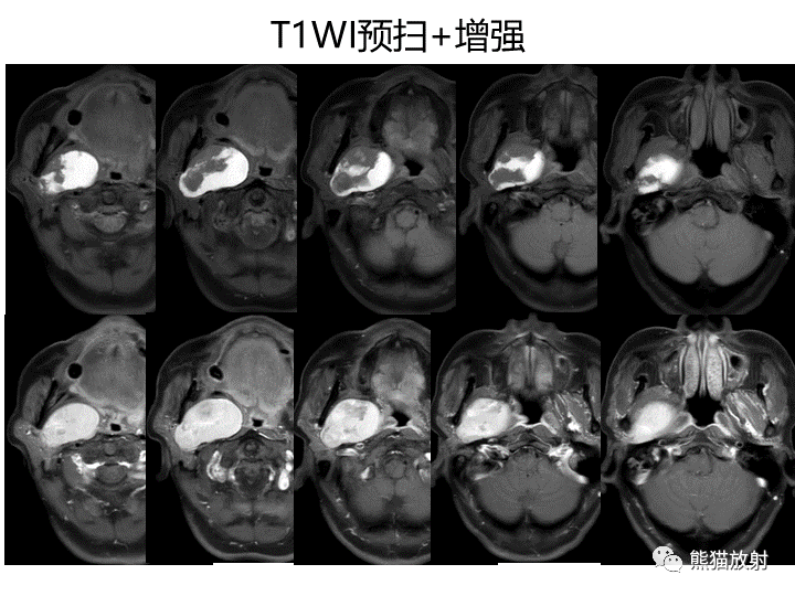 影像PPT - 【病例】咽旁多形性腺瘤VS神经鞘瘤-6