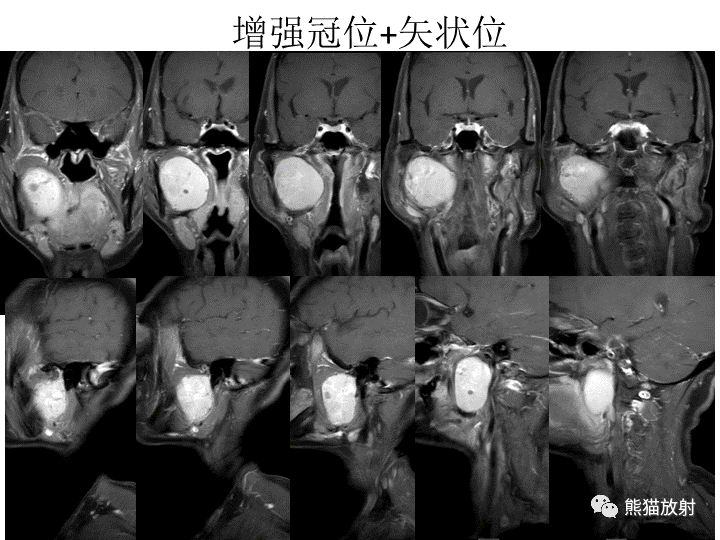 影像PPT - 【病例】咽旁多形性腺瘤VS神经鞘瘤-7