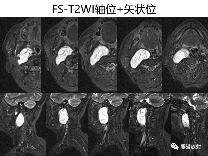 影像PPT - 【病例】咽旁多形性腺瘤VS神经鞘瘤-11
