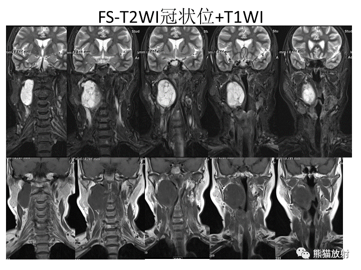 影像PPT - 【病例】咽旁多形性腺瘤VS神经鞘瘤-12