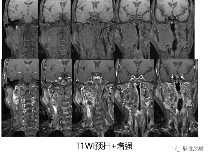 影像PPT - 【病例】咽旁多形性腺瘤VS神经鞘瘤-14