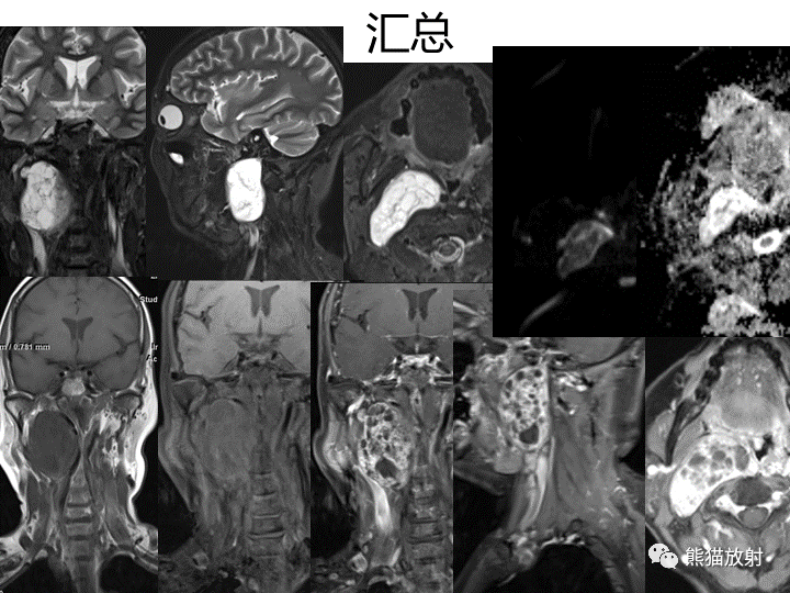 影像PPT - 【病例】咽旁多形性腺瘤VS神经鞘瘤-16