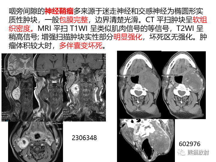 影像PPT - 【病例】咽旁多形性腺瘤VS神经鞘瘤-26