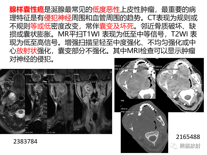 影像PPT - 【病例】咽旁多形性腺瘤VS神经鞘瘤-27
