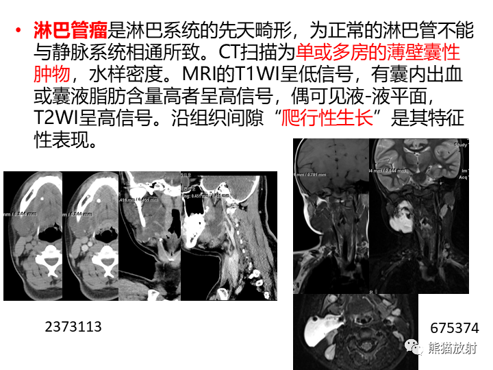影像PPT - 【病例】咽旁多形性腺瘤VS神经鞘瘤-29